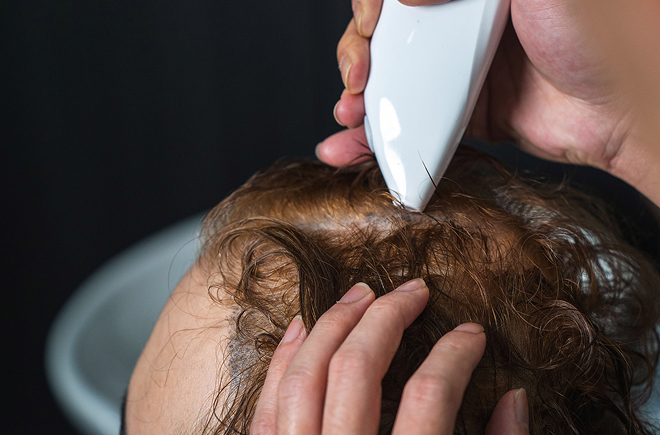 Best Hair Loss Treatment Singapore with Cutting-Edge Hair Growth Technology