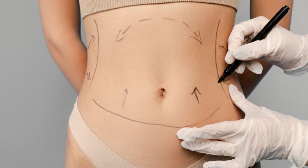 Sculpting the Silhouette: Why Lipo Is About Shape, Not the Scale